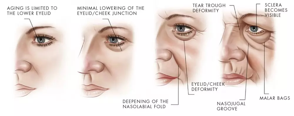 Causes of dark circles under the eyes