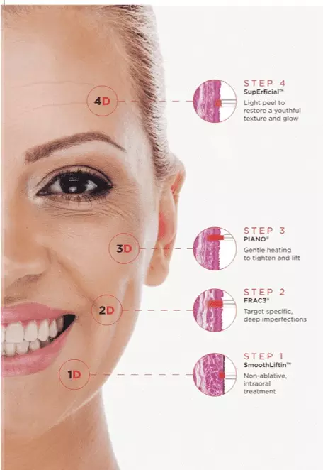 Fotona 4D Laser Facelift
