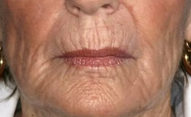 Mouth wrinkle treatment without surgery