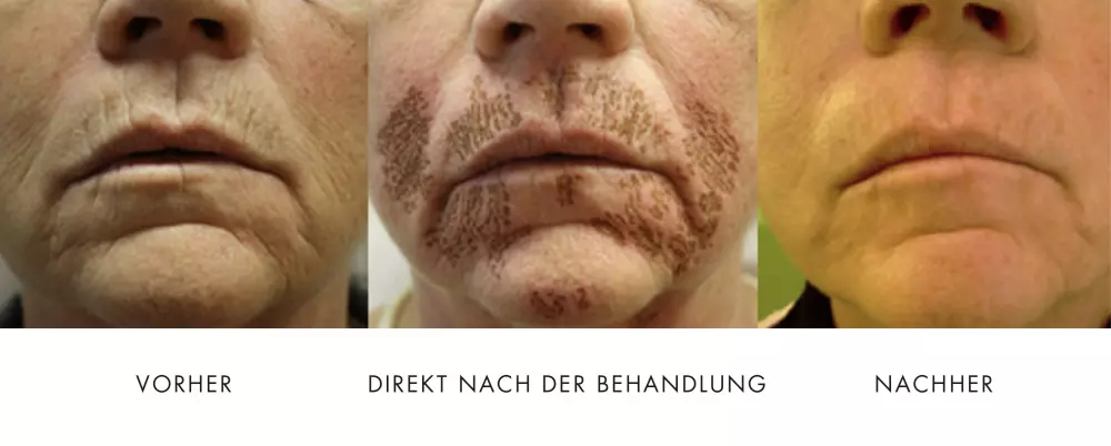 Plexr Plasma Pen Ablauf