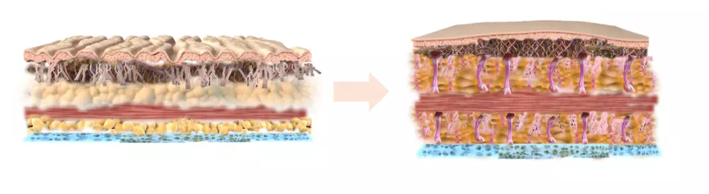 Po augmentation without surgery