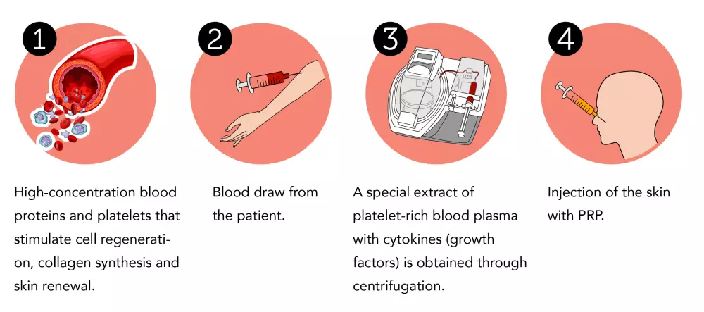 PRP beauty treatment Switzerland