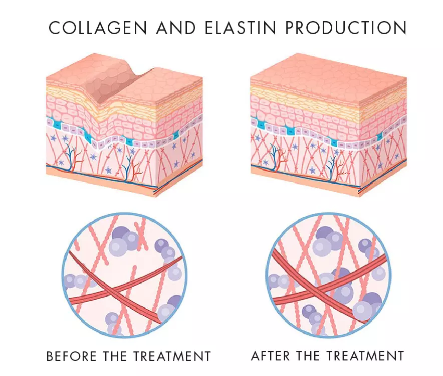 RF Microneedling