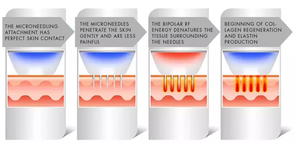 RF Microneedling