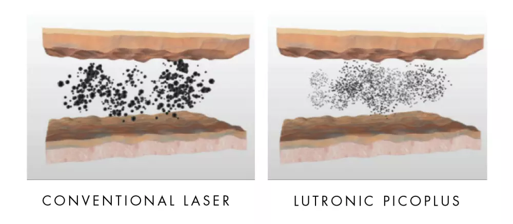 Tattoo removal Pico Plus Switzerland