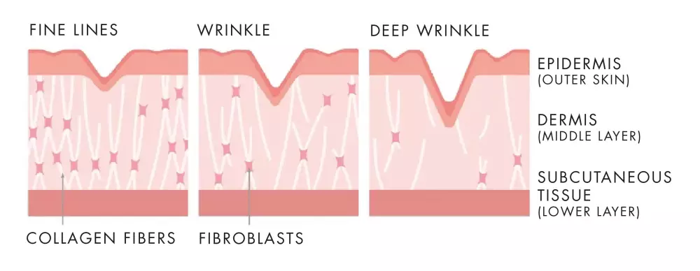 Types of wrinkles