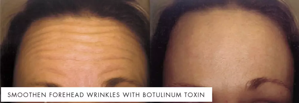 Treat forehead wrinkles