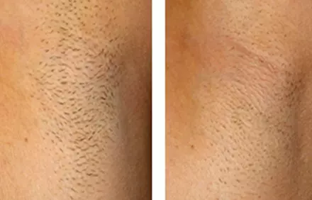haarentfernung mit laser