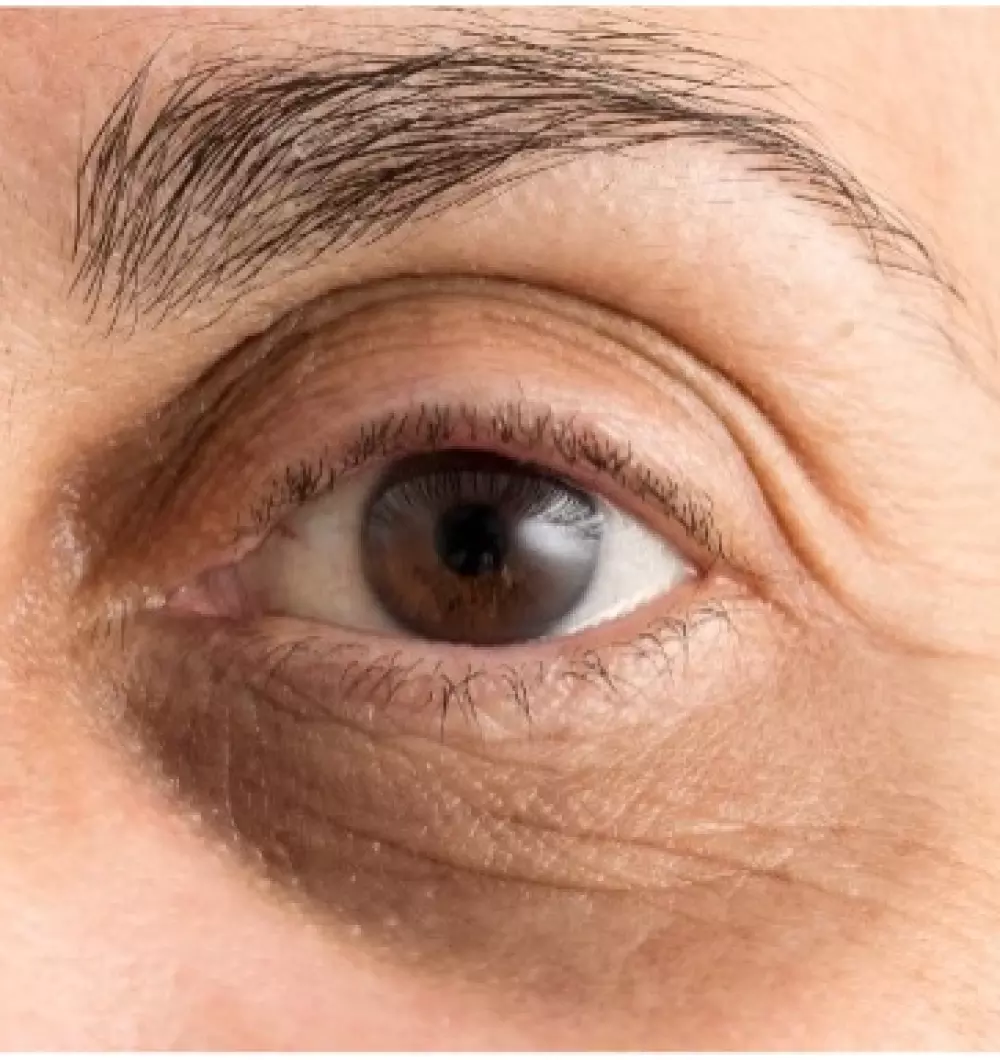 Augenringe