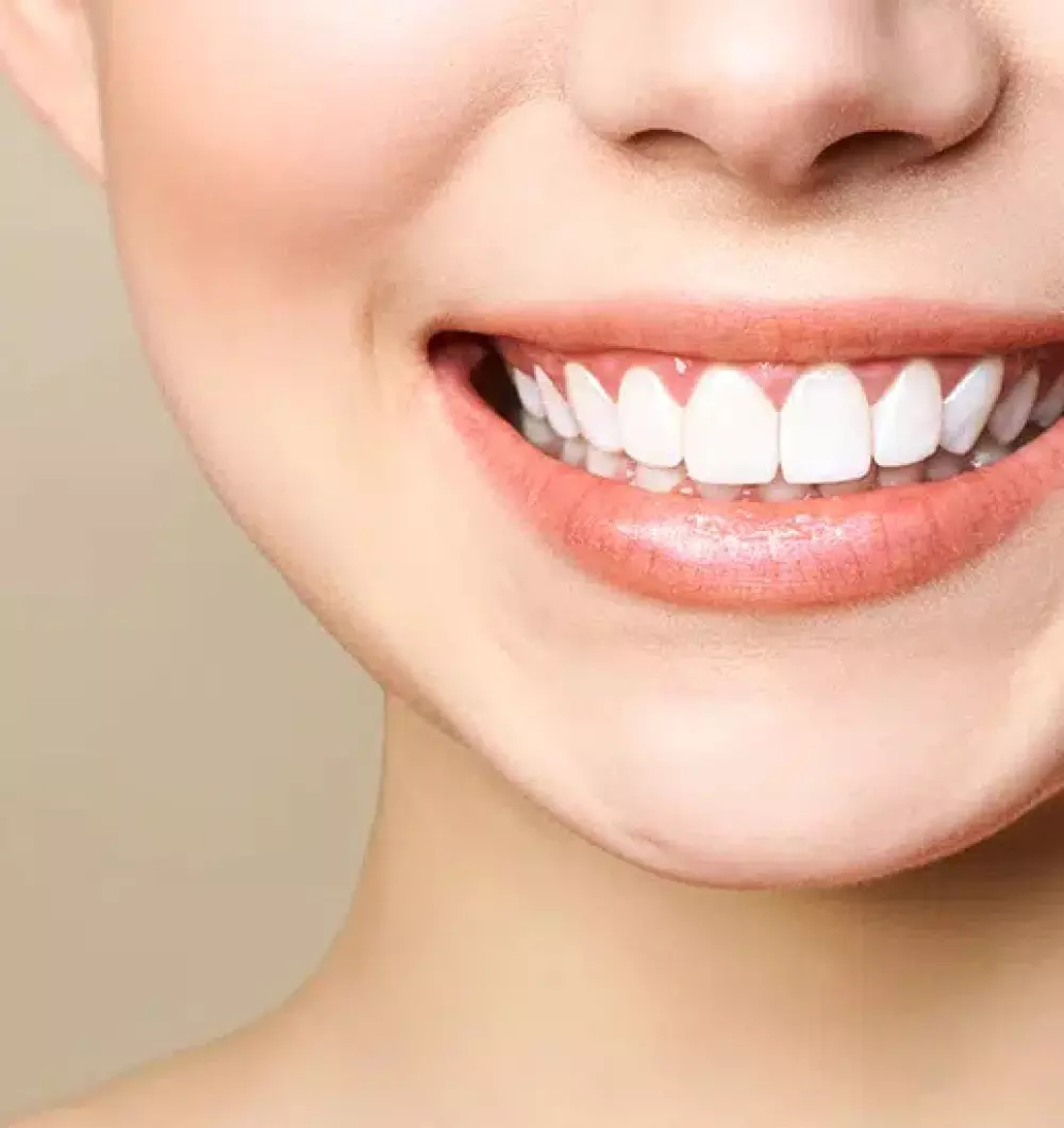 Gummy Smile