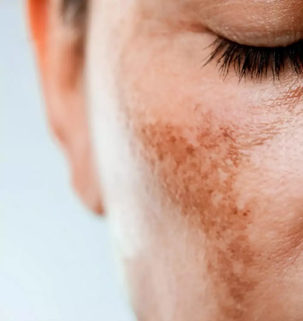 Melasma