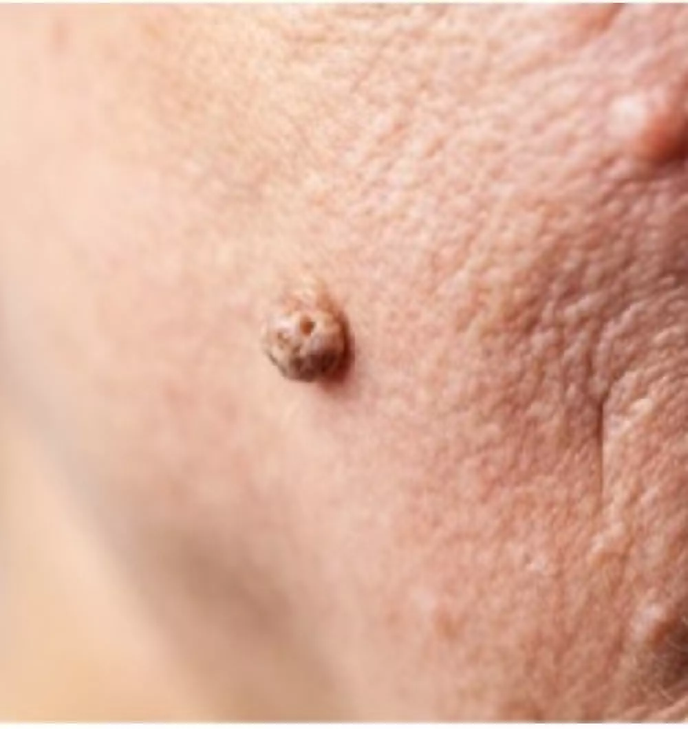 Birthmark removal