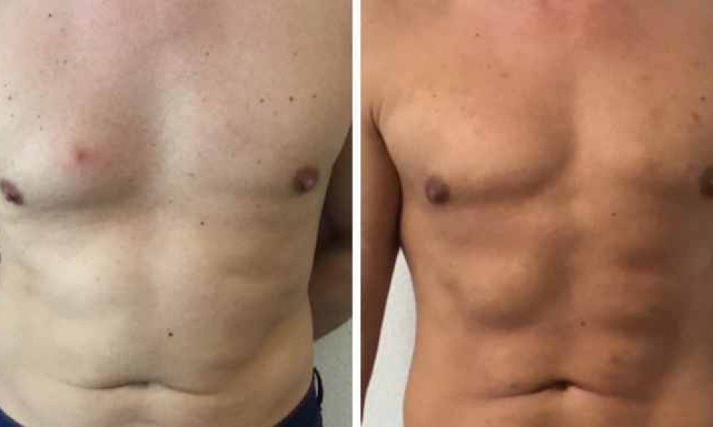 Sixpack OP Mann: Vorher-Nachher-Bilder