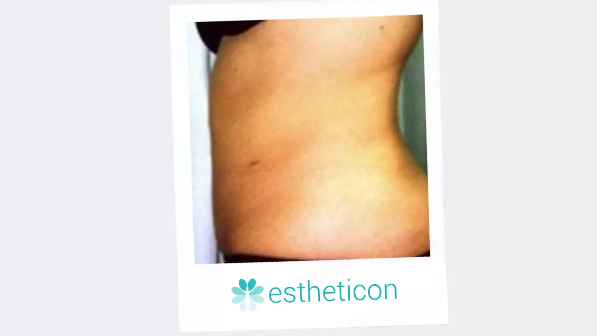 Liposuktion am Bauch - TOP Eingriff
