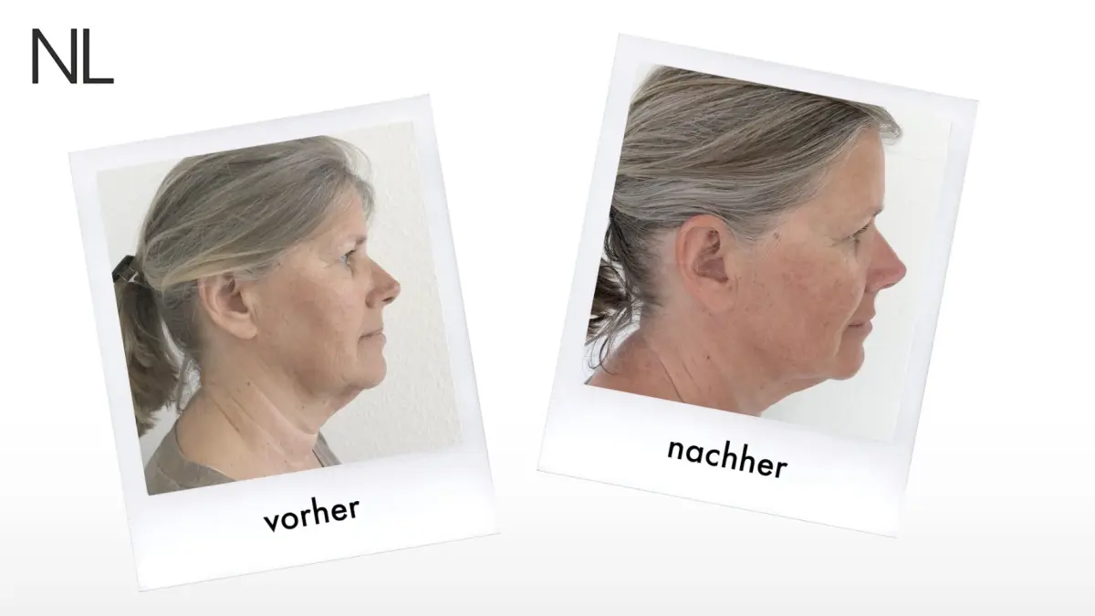 Fadenlifting und Faltenbehandlung im Gesicht