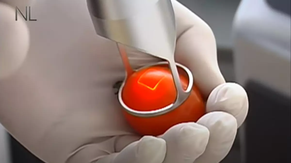 Dr. Linde - Fraktionierter CO<sub>2</sub> Laser gegen Falten und alternde Haut