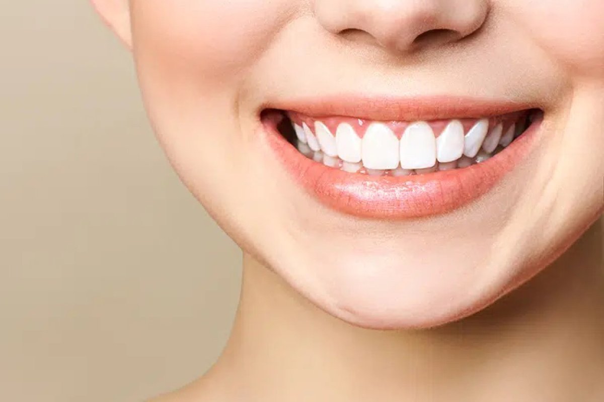 Gummy Smile