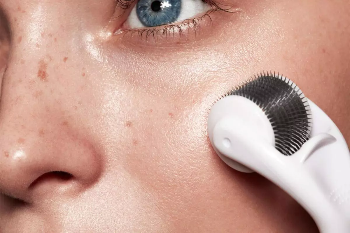Microneedling